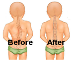 scoliosis